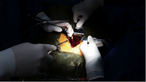 cirurgia artrodese via anterior