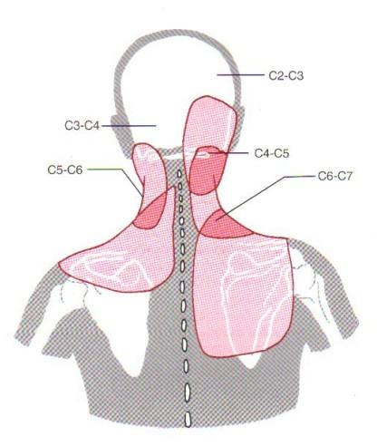 Distribuição da dor facetária cervical